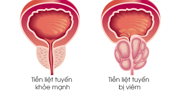 viêm tiền liệt tuyến