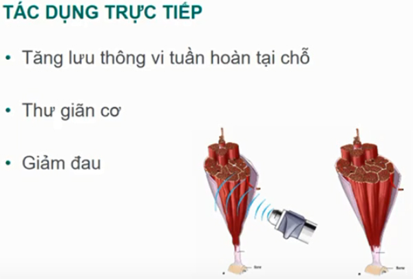 máy điều trị bằng sóng xung kích