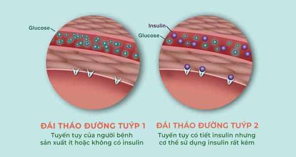 Sự khác biệt của bệnh tiểu đường tuýp 1, tuýp 2 và cách phòng tránh