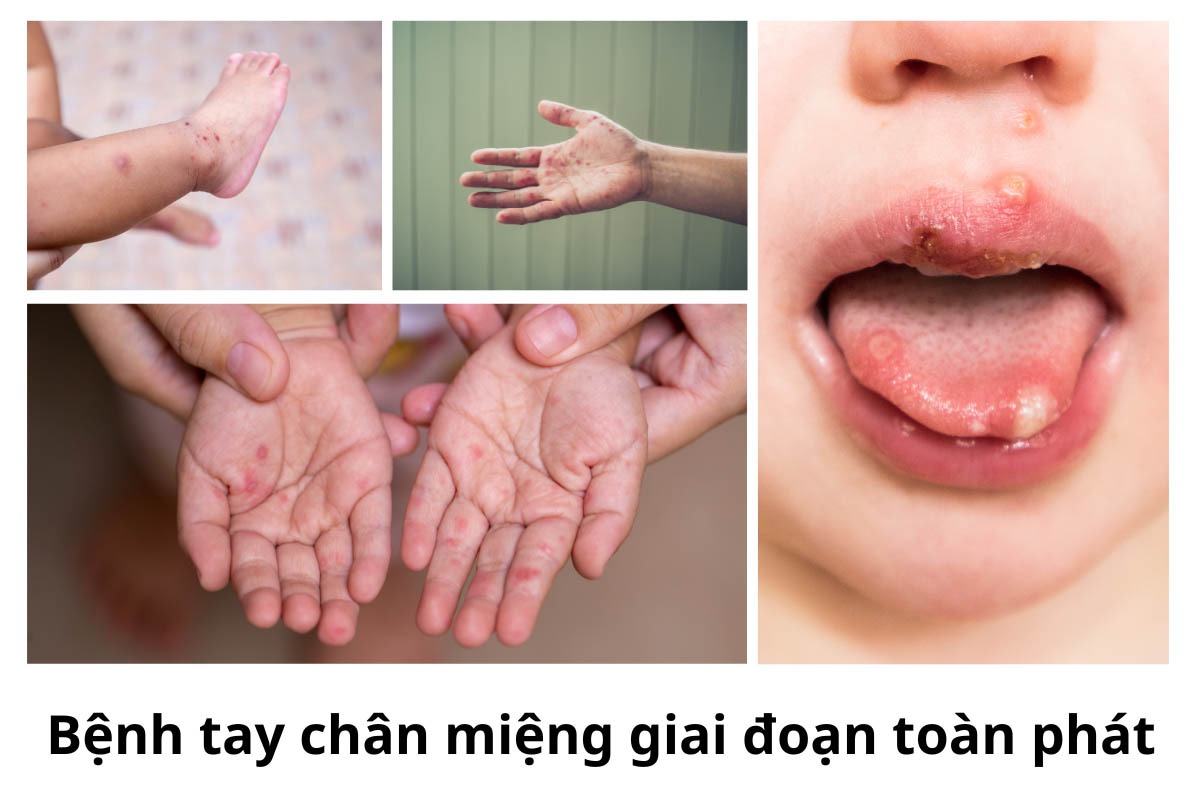 Gia tăng ca mắc tay chân miệng, dấu hiệu cha mẹ cần lưu ý- Ảnh 2.