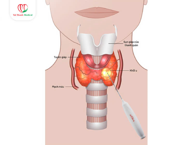 kim máy đốt sóng cao tần u tuyến giáp